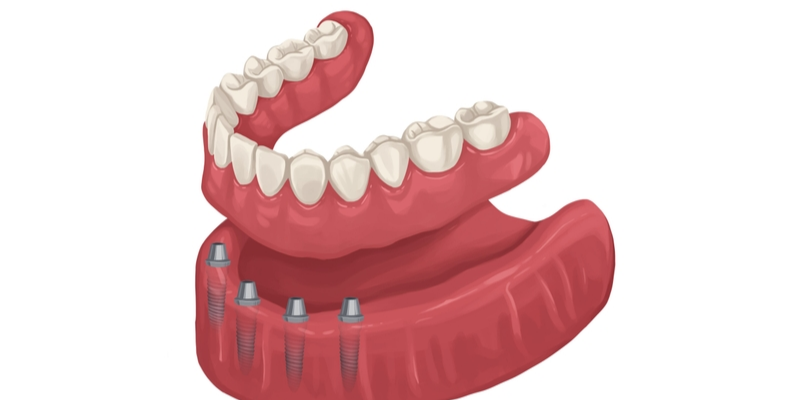 Full-Arch Dental Implant Surgery: Recovery